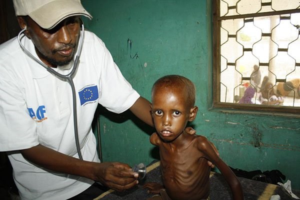 A doctor prepares four-year-old Fatuma Ibrahim for a check up at a medical camp in Somalia. Malnourished children have become the posterchild of hunger and famine in Baidoa. PHOTO | XINHUA.